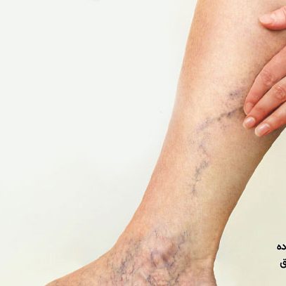 علت واریس پا در جوانی