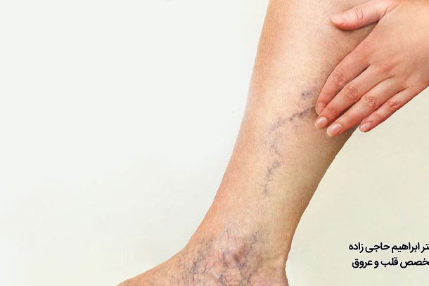 علت واریس پا در جوانی