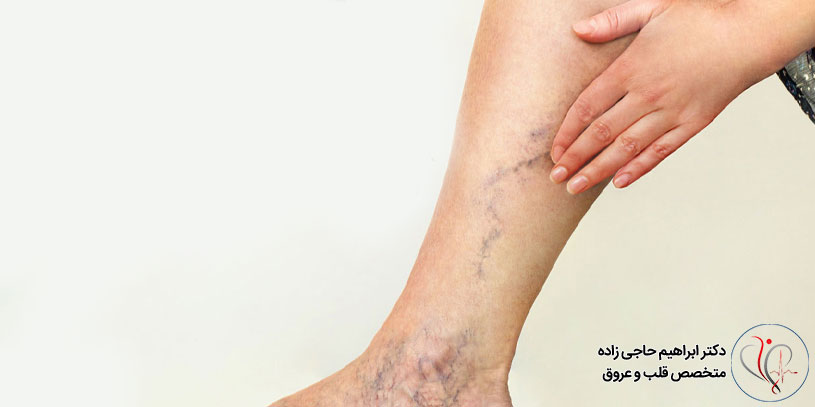 علت واریس پا در جوانی