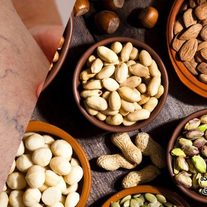 تغذیه مناسب بعد از عمل واریس پا