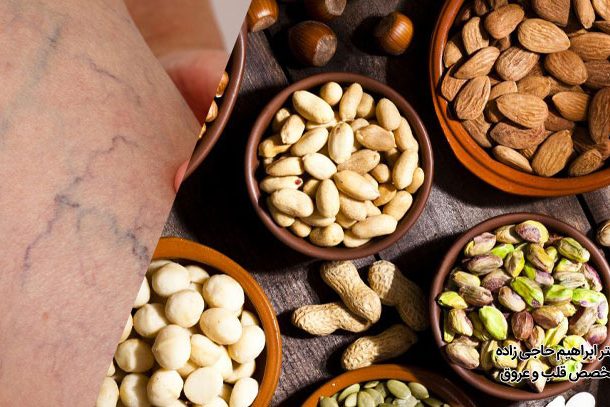 تغذیه مناسب بعد از عمل واریس پا