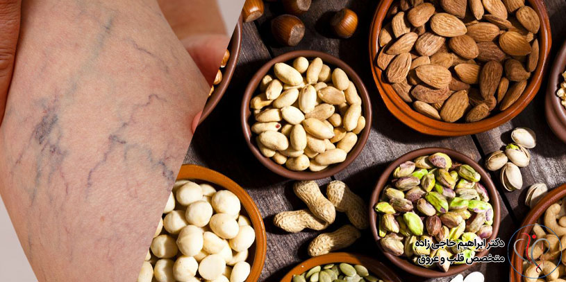 تغذیه مناسب بعد از عمل واریس پا